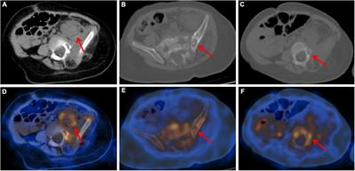 Case report: A rare case of retroperitoneal kaposiform hemangioendothelioma with spinal involvement without abnormal platelet count in 18F-FDG PET/CT